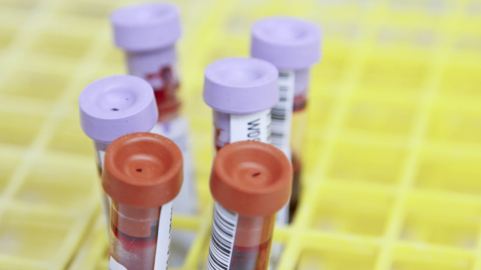 Lab technician processing blood tubes for liver testing.